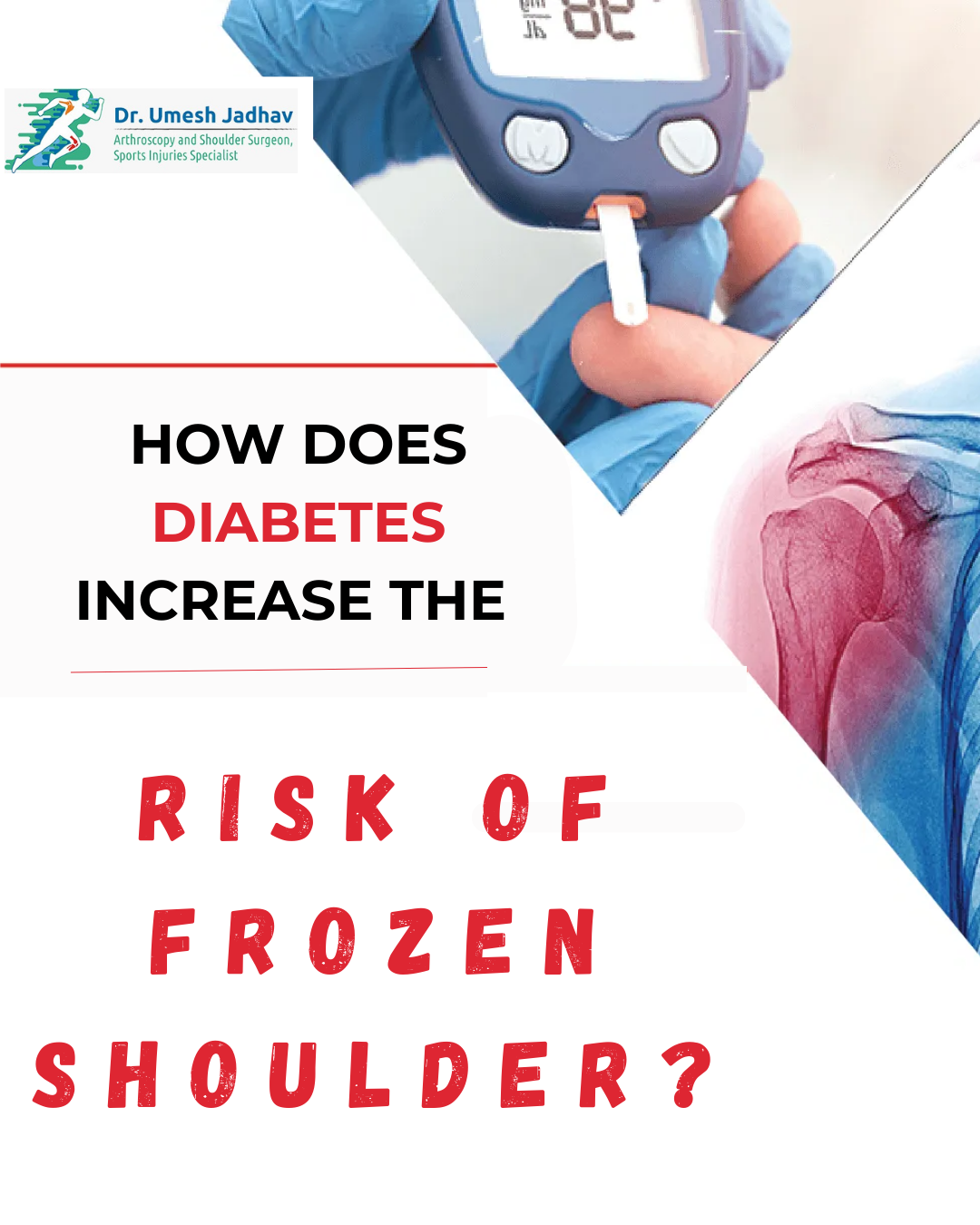 How Does Diabetes Increase the Risk of Frozen Shoulder?