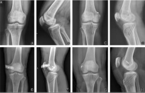 cartilage degeneration in pcmc